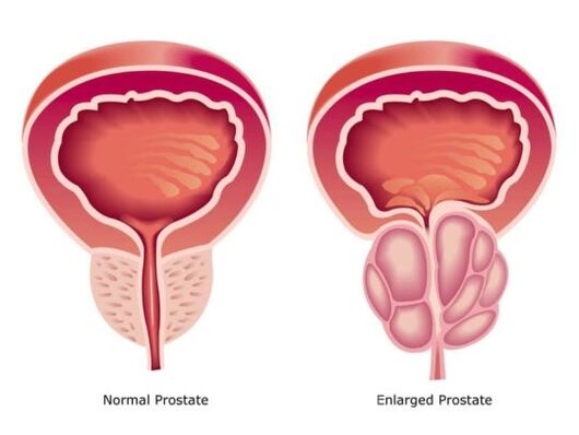 Prostata normalna i przerostowa