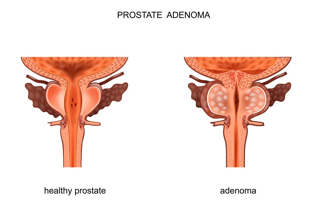 prostata zdrowa i z gruczolakiem